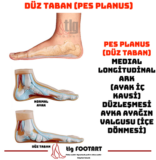 DÜZ TABAN (PES PLANUS)